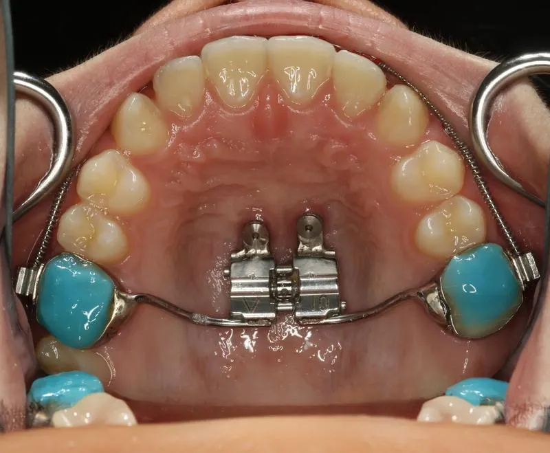 Ile zapłacisz za aparat ortodontyczny? Ceny i porównania w jednym miejscu